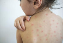 Casos no exterior acendem alerta para possível reintrodução do sarampo em MS