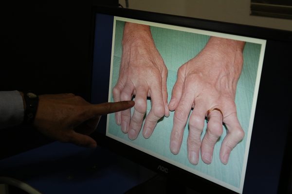  Doença pode evolui e causar agravantes nas articulações