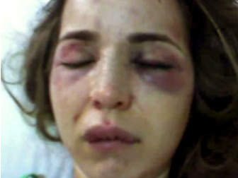 Por conta das agressões, a vítima ficou com boca inchada e teve o dedo indicador da mão direita machucado e o rosto vermelho.Foto: Divulgação