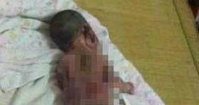 O bebê foi retirado da incubadora com as pernas, pés escurecidos e avermelhados pela queimadura. No corpo foi encontrado também várias bolhas e feridas.Foto: Reprodução 