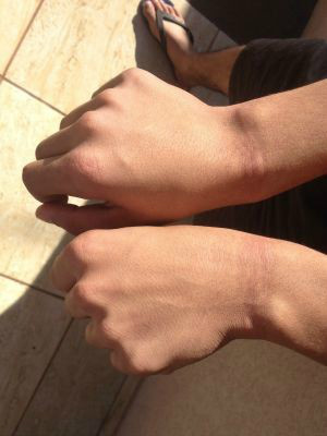 Rapaz de 18 anos mostra marcas dos fios nasmãos (Foto: Ronie Cruz/G1 MS)