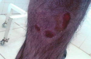 Adolescente ficou com vários ferimentos pelo corpo, após ser agredido pelo pai. (Foto: divulgação