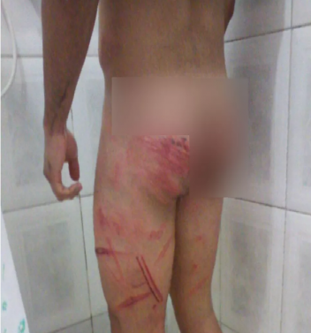 Soldado ficou com marcas no corpo após agressões (Foto: Arquivo Pessoal)