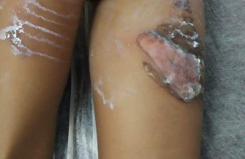 Menina sofreu queimaduras de 2º grau na parte detrás das pernas e no bumbum (Foto: Polícia Civil/Divulgação) 