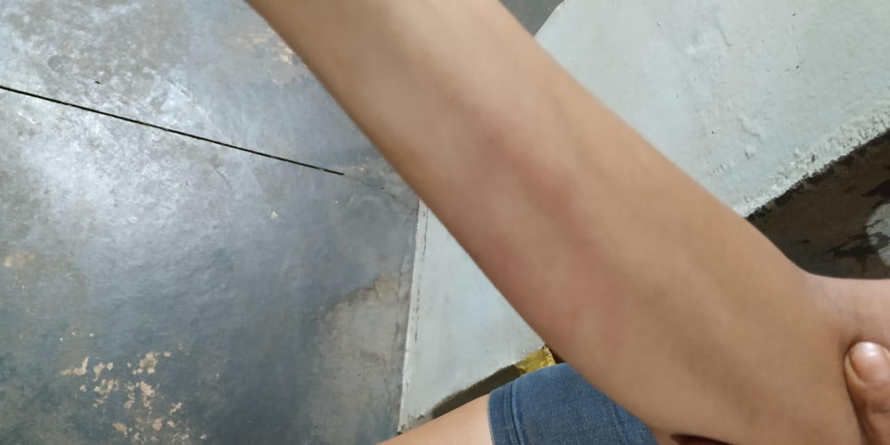 Imagem: Hematomas no braço da vítima // 2°BPM - Três lagoas