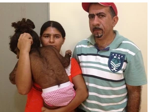 Kemilly Vitória nasceu com o corpo cobertode pelos