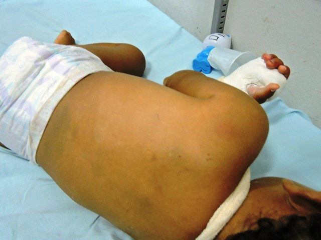 Duas fraturas no braço direito,queimadura no braço esquerdo,inchaço no crânio e hematomas nas costas.Foto:Rádio Caçula