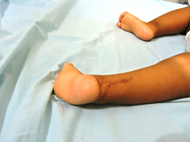 Corte no tornozelo esquerdo mas a criança não foi levada para o hospital para atendimento médico.Foto Rádio Caçula