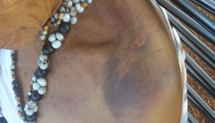 Indígena mostra sinal de tortura. (Foto: Reprodução/Redes sociais)