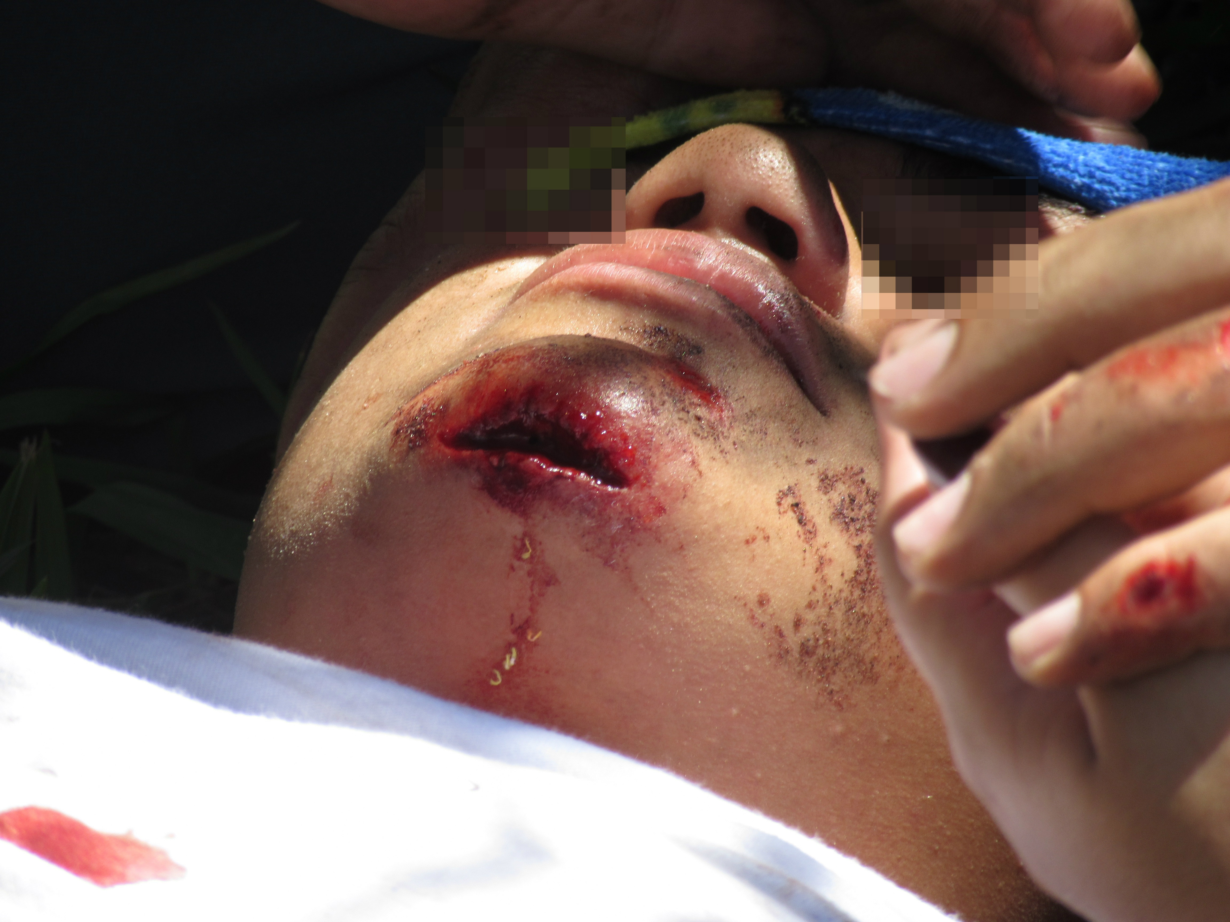 Adolescente de 16 anos fica ferido ao cair de patinete na Av. Eloy Chaves e Três Lagoas.Rádio Caçula