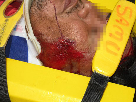 corte na testa e escoriações na face (Foto Rádio Caçula)