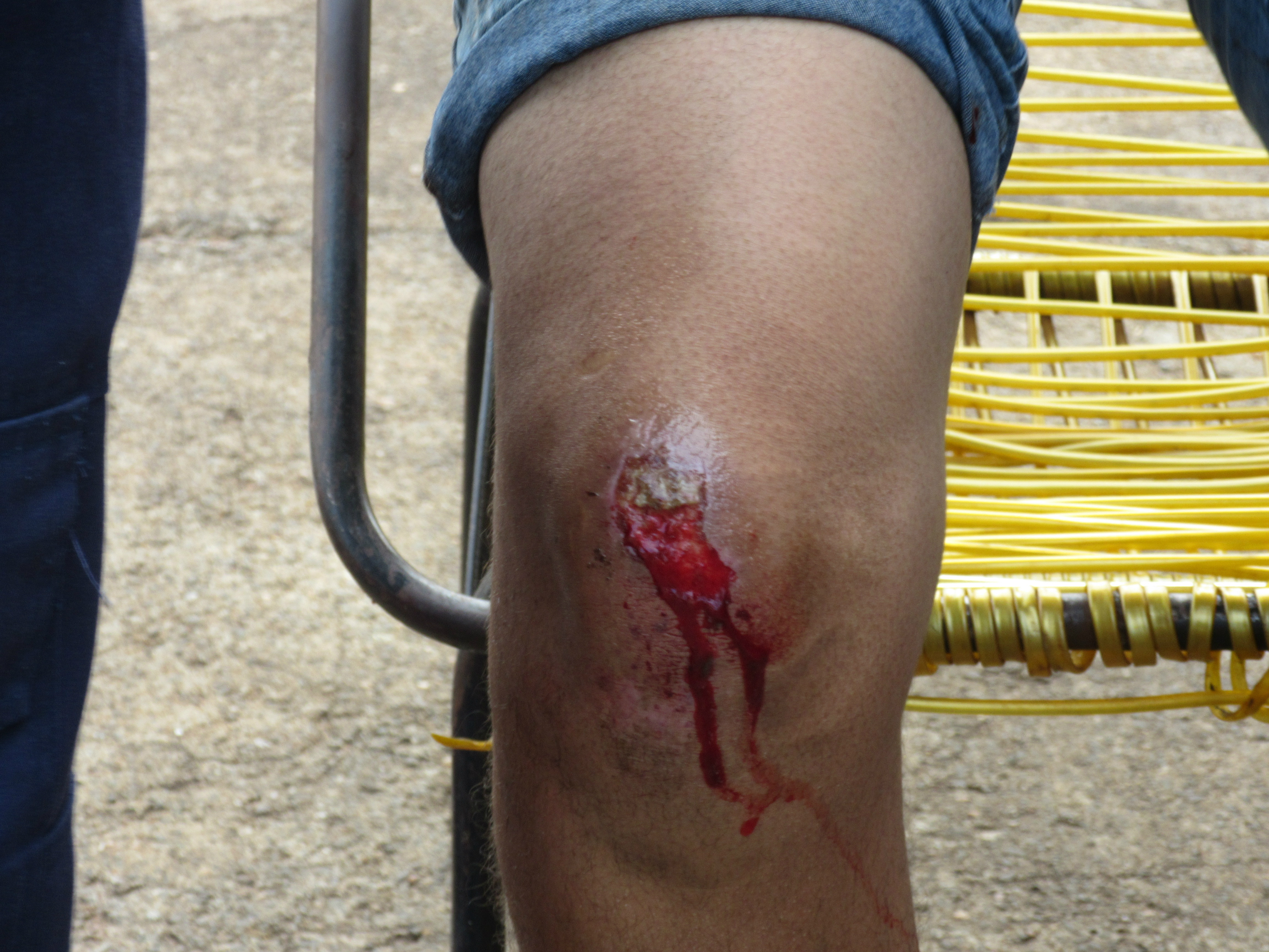 O motociclista sofreu m ferimento de extensão media no joelho direito Foto: Rádio Caçula