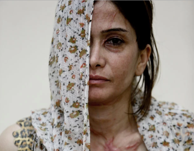 A síria Andi, de 30 anos; ela veio para o Brasil com o marido, após ser atacada com ácido em sua cidade natal. (Foto: Gabriel Chaim/G1)