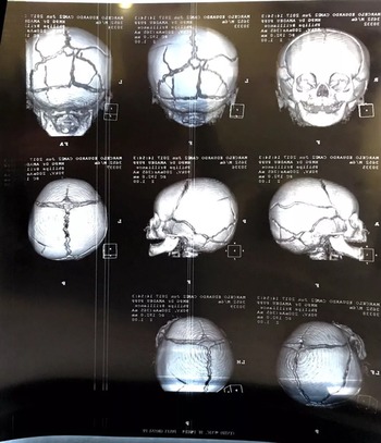 Bebê de seis meses é internado com várias fraturas no crânio; suspeita é de agressão (Foto: Reprodução/RPC)