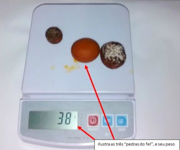 Autor possuía três pedras de fel furtadas da unidade frigorífica - Imagem: Polícia Civil