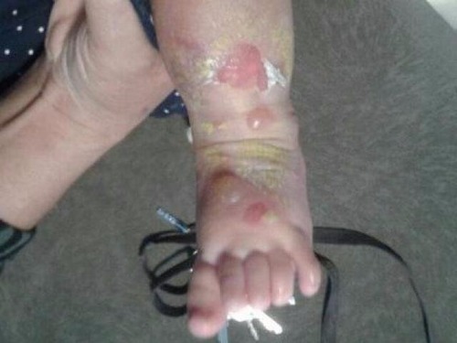 Bebê ficou com queimaduras no pé e em parte da perna. (Foto: Direto das ruas)