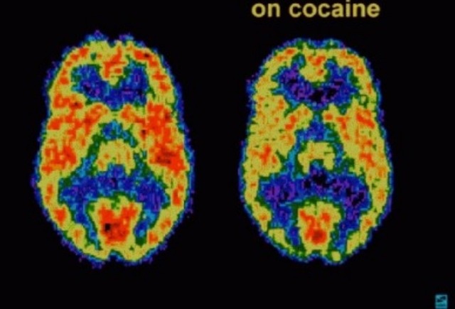 Grupo da Faculdade de Medicina da USP combinou análise de déficits cognitivos e do padrão de uso da droga para identificar os pacientes com risco aumentado de recair após o tratamento (Tomografia por emissão de pósitrons (PET) revela como a cocaína altera o metabolismo de glicose no cérebro; imagem: National Institute on Drug Abuse)