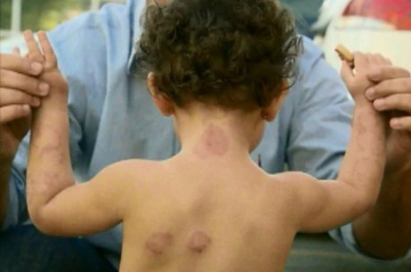 A menina focou com marcas roxas por todo o corpo.Foto: Record Minas