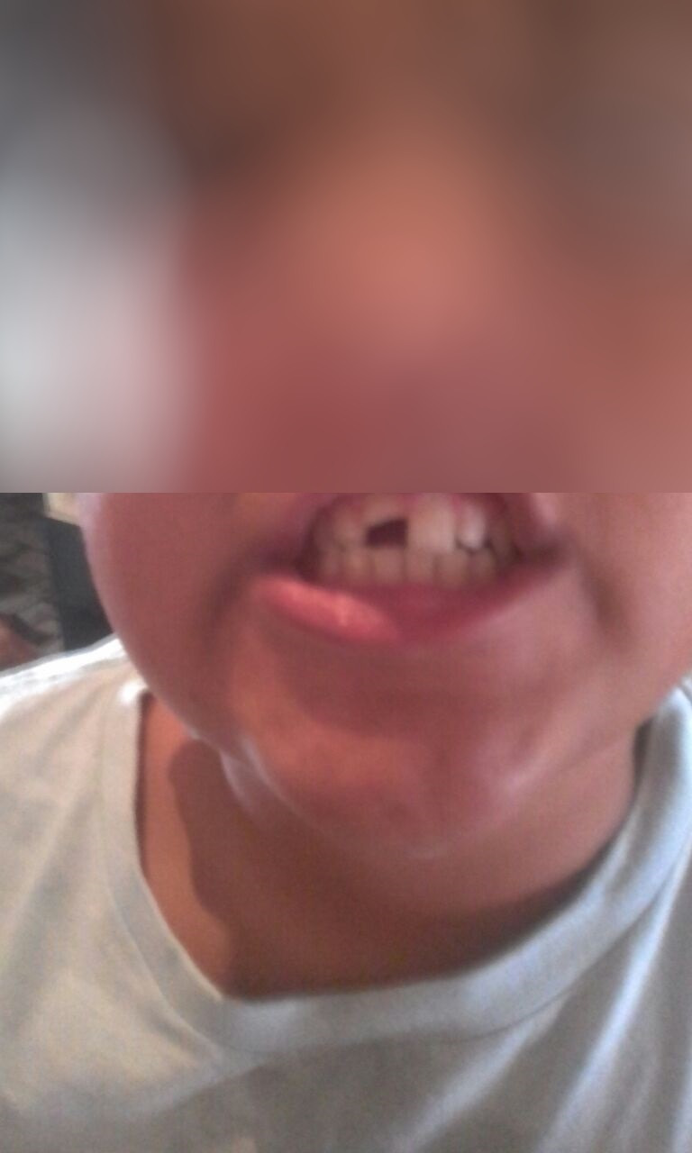 O menino caiu e quebrou o dente da frente, e agora sofre bullying na escola porque a família não tem condições de arcar com o procedimento de estética. 