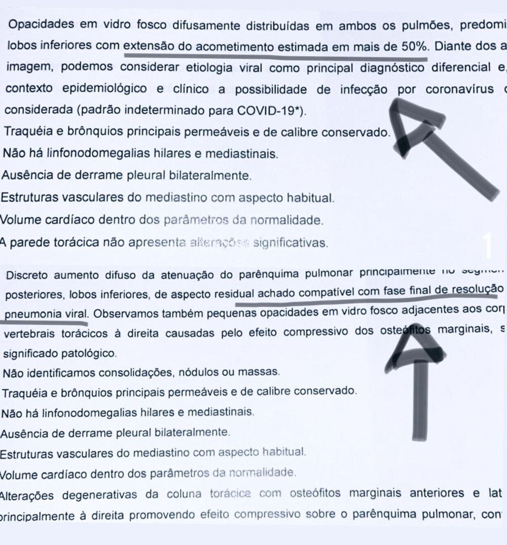 Mesmo exame feito por contabilista durante tratamento da Covid; no primeiro estava com 50% do pulmão comprometido — Foto: Montagem/G1 MS