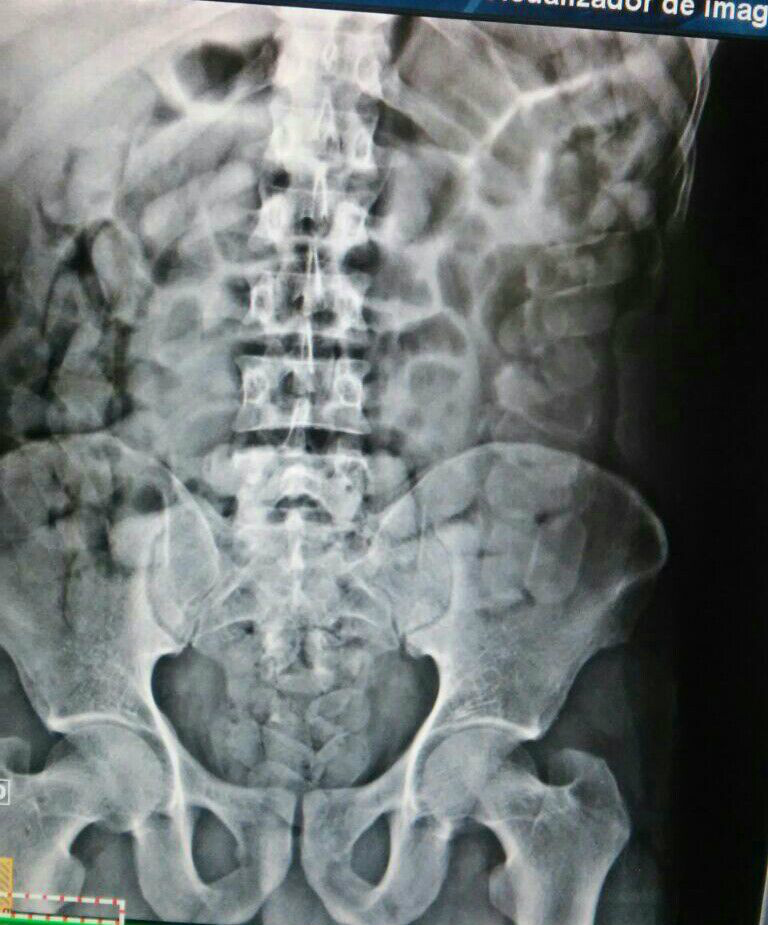 52 cápsulas totalizando aproximadamente 650gr de cocaína (Foto Rádio Caçula)