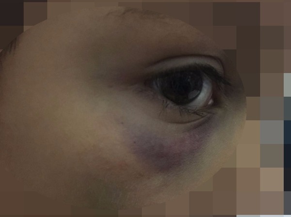 Menino agredido pelo pai em Sorocaba ficou com hematoma no rosto (Foto: Conselho Tutelar de Sorocaba/Divulgação)
