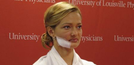 Lessya Kotelevskaya, que teve o rosto desfigurado por um tratamento de radioterapia para curar um câncer que nunca teve, no Cazaquistão, participa de coletiva de imprensa dada pela equipe médica do hospital universitário de Louisville, no Estado de Kentucky, nos EUA, onde passará por cirurgia de reconstrução