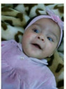 Ana Beatriz, de 7 meses, está fazendo tratamento cirúrgico contra catarata congênita.