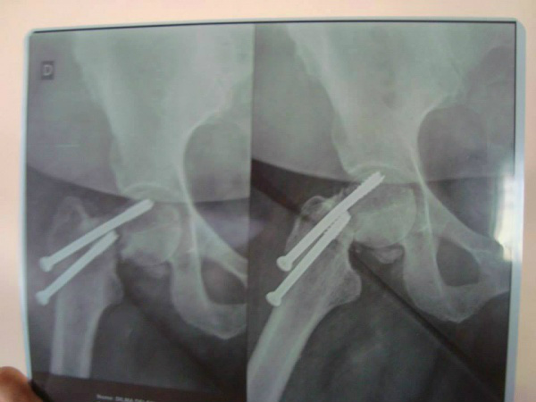 Pinos e cirurgia mal sucedida impedem a aposentada de andar.Foto: Arquivo/ Facebook