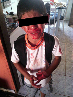 Criança de 7 anos, agredida por Valentão de 9 anos, da escola