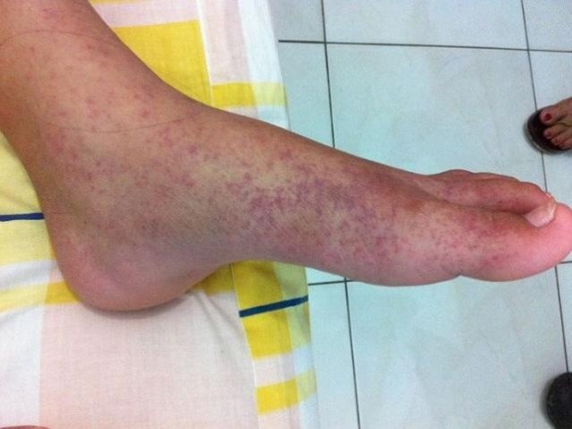 Dor intensa nas articulações de início agudo, acompanhada ou não de inchaço são alguns dos sintomas. (Foto: Reprodução/Internet)