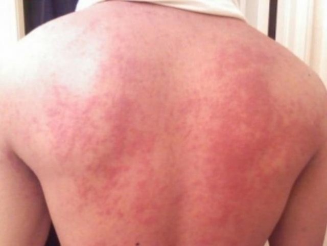 No surto de 2016, em Mato Grosso do Sul, foram confirmados 343 casos. (Foto: Reprodução/Internet)