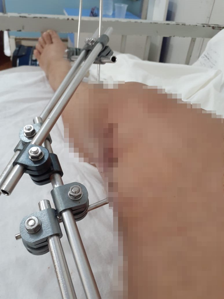 Ana Lúcia sofreu fratura exposta de fêmur e esmagamento de joelho. Foto: Arquivo pessoal.