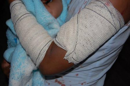 Mulher com braços feridos, machas de sangue na roupa e o bebê no colo