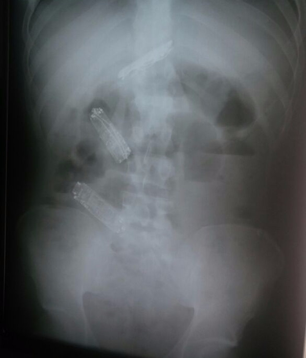 Preso tinha três celulares no estômago (Foto: SAP/Cedida)