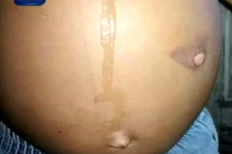 Garoto foi encontrado com marcas de queimaduras na mão e na barriga