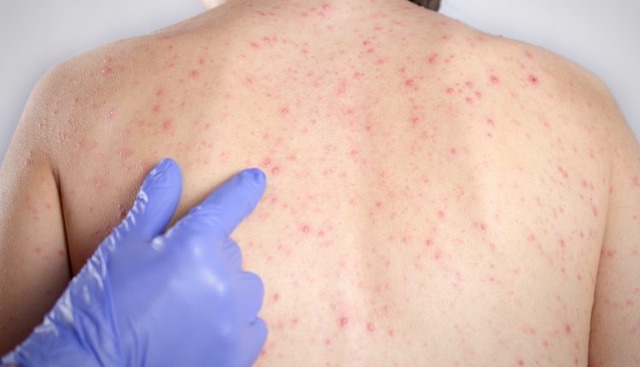 De acordo com a secretaria, quinze casos já foram descartados e os outros estão sob análise - Foto: Ilustração