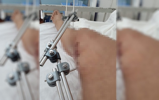 Ana Lúcia está a quase 30 dias esperando uma operação para voltar a andar. Foto: Arquivo pessoal.