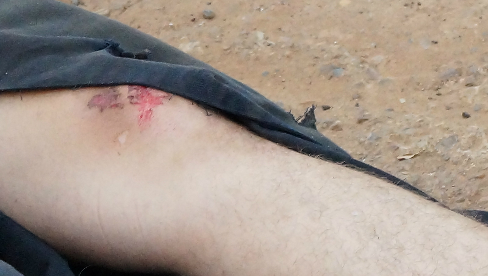 Os dois condutores sofreram diversas escoriações pelo corpo. Foto: Rádio Caçula