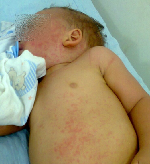 A alergia só foi descoberta no centro médico de Andradina-MS. Foto: Arquivo Pessoal