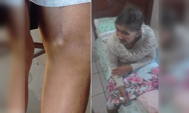 Há cerca de três meses atrás, dona Maria sofreu um acidente que acabou quebrando seu fêmur - Fotos: Arquivo Pessoal