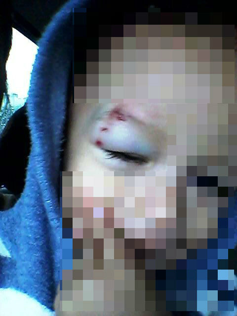 Criança ferida busca atendimento em dois Hospitais de Três Lagoas mas não encontra pediatra em nenhum deles.