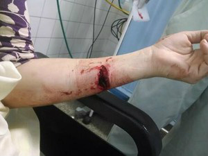 Jornalista da CNN postou a foto de seu braçoferido durante protesto (Foto: Reprodução/Twitter)